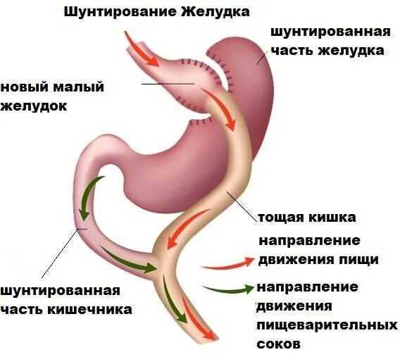 Бариатрическая операция нижний новгород. Желудочное шунтирование схема операции. Бариатрическая операция гастрошунтирование. Бариатрическая операция шунтирование. Желудочного шунтирования Roux-en-y..