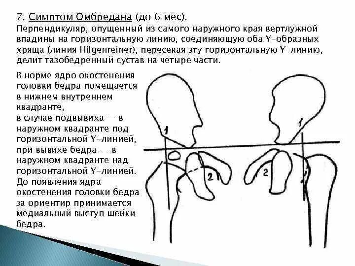 Углы суставов ребенка норма. Схема хильгенрейнера тазобедренных суставов. дисплазия тазобедренных суставов ацетабулярный угол норма. схема хильгенрейнера при врожденном вывихе бедра. линия омбредана паркинсп.