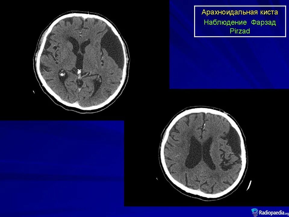Киста головного мозга армия. Арахноидальная киста мозжечка кт. Ретроцеребеллярная арахноидальная киста кт. Киста задней черепной ямки кт. Арахноидальная киста кт классификация.