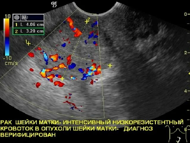 Ультразвуковое исследование шейки матки при раке.. Рпкмшейки матки на УЗИ. Опухоль шейки матки на УЗИ. Рак матки на узи виден