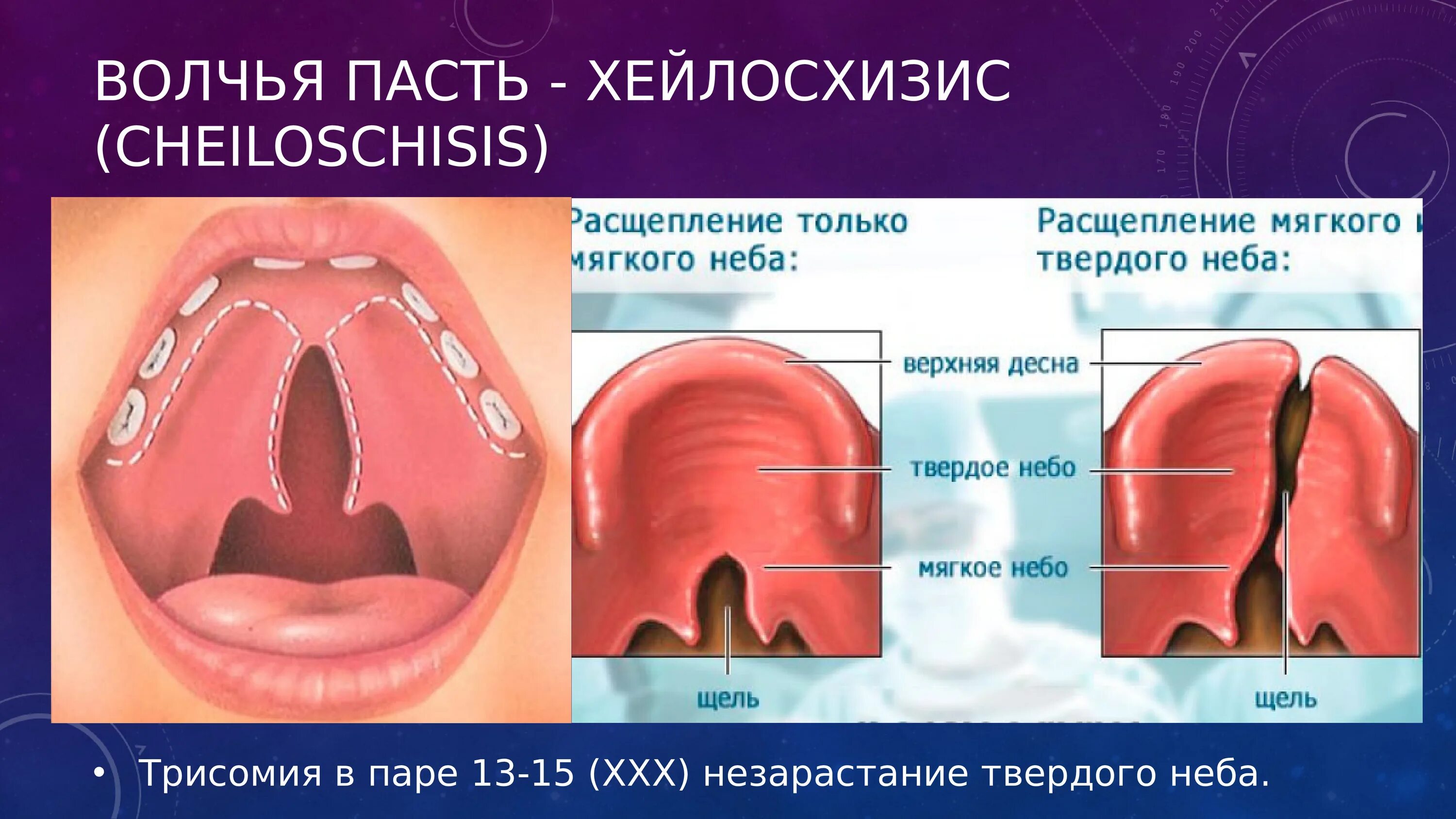 Расщепление латынь. Волчья пасть расщелина твердого неба. Расщепление неба Волчья пасть. Расщепление твердого неба. Врожденная расщелина мягкого неба.