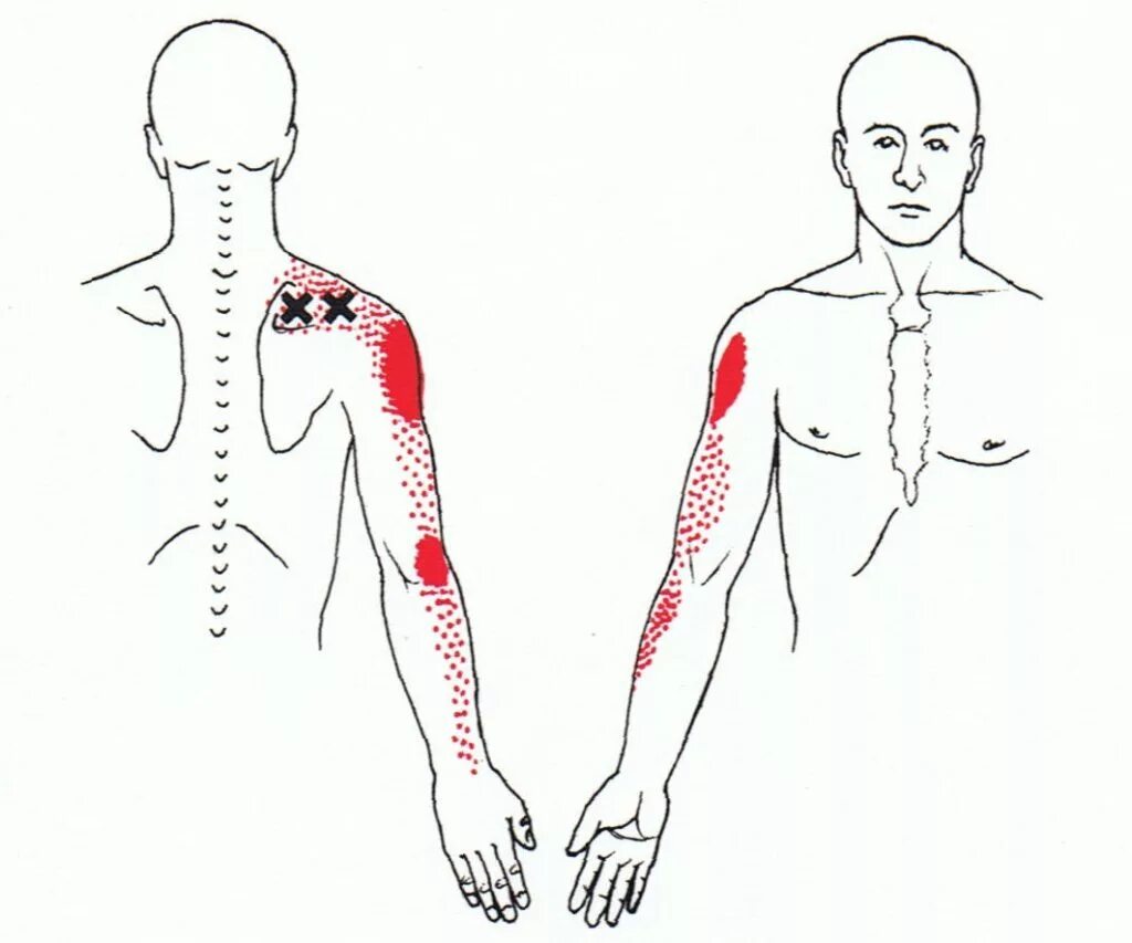 Иррадиация боли в ногу. Миофасциальный синдром плеча. Триггерные точки грудной клетки. Миофасциальный болевой синдром подостной мышцы. Миофасциальный синдром лопаточной области.