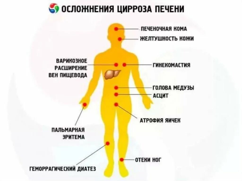 Симптомы плохой печени. Периферические признаки цирроза печени. Цирроз печени ранние симптомы. Признаки церроз печени. Цирроз печени признаки и симптомы.