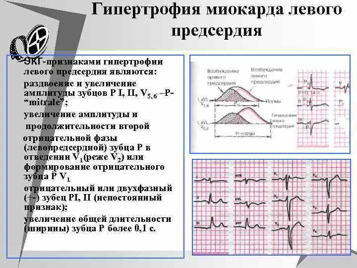 Гипертрофия левого предсердия левого желудочка. Критерии гипертрофии левого предсердия на ЭКГ. Признаки гипертрофии левого предсердия на ЭКГ. ЭКГ - синдром гипертрофии предсердий.. Гипертрофия левого предсердия на ЭКГ.