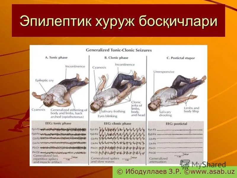 Бывшие эпилептики. Поведение эпилептиков. Характер эпилептика. Известные эпилептики.