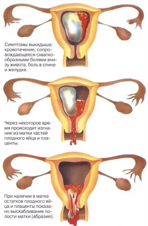 последний день овуляции. как начинаются месячные у девочек. когдатначитаются месячные. как понять что пошли месячные. признаки первых месячных у девочек.