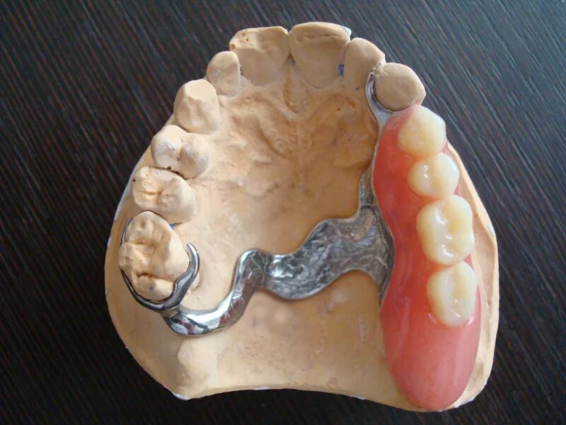 07. зубы бюгельные протезы фото на верхнюю. бюгельный протез кламмерный (remanium-700). зубы бюгельные протезы фото на верхнюю. бюгельный протез литой базис.