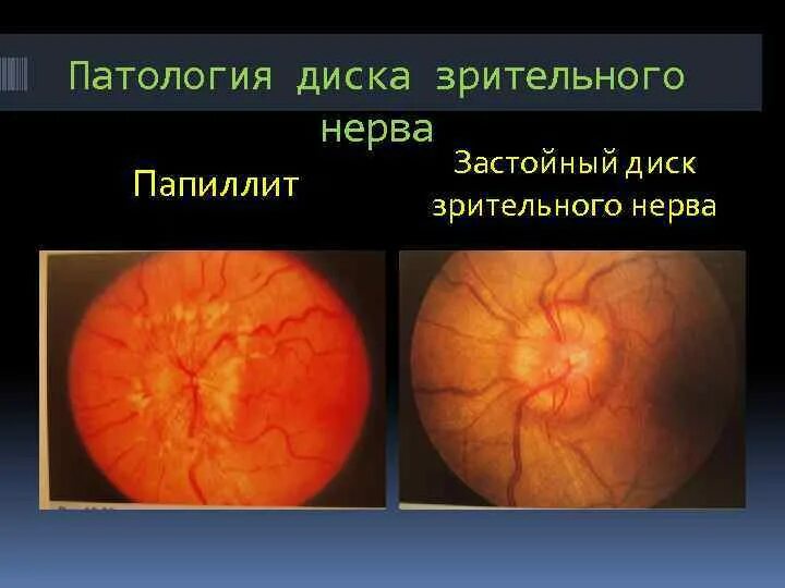 Папиллит диска зрительного нерва. Застойный диск зрительного нерва дифференциальная диагностика. Интрабульбарный неврит зрительного нерва. Ретробульбарный неврит глазное дно.