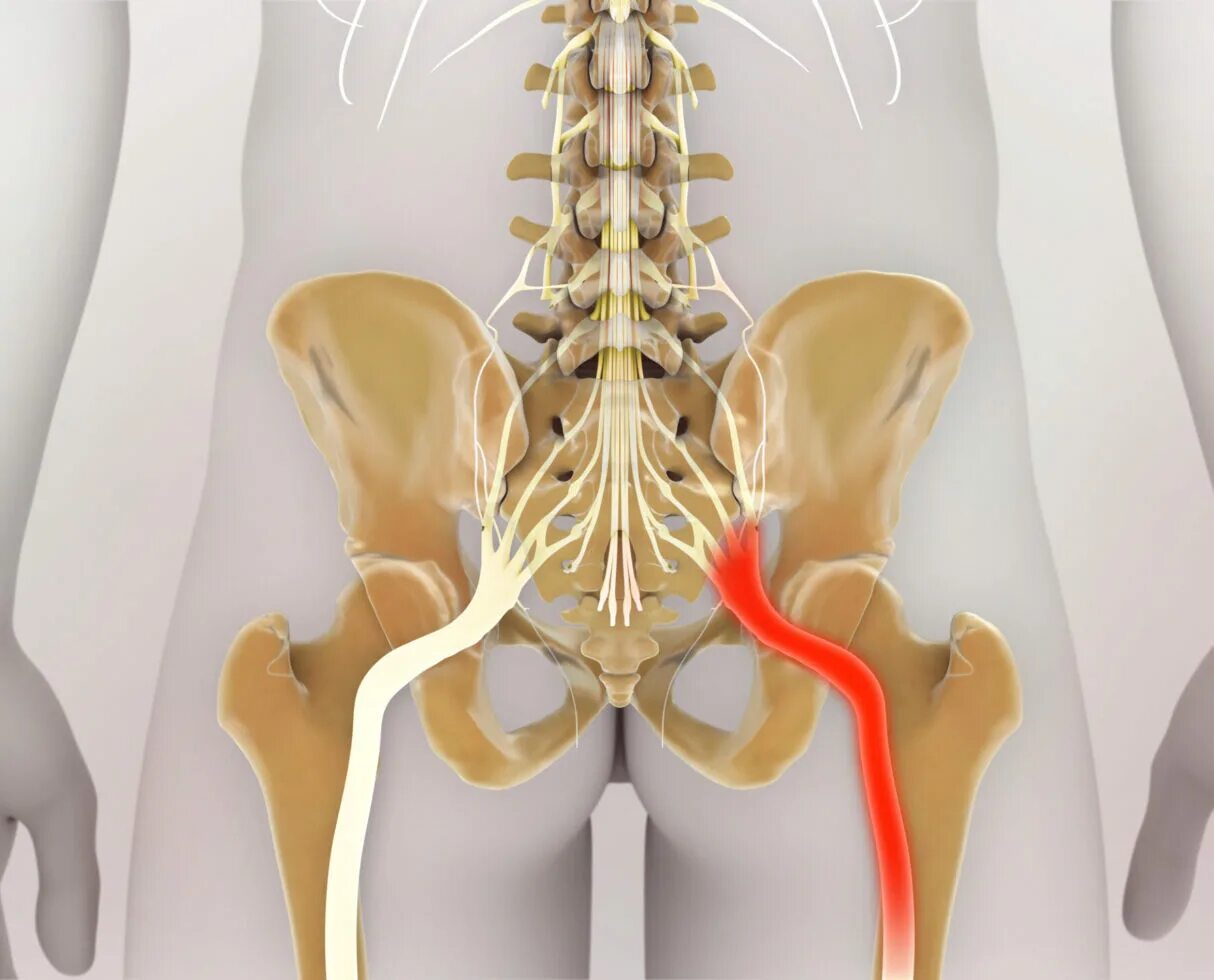 Болит поясница слева и нога. Ишиас воспаление седалищного. Ишиас - защемление седалищного нерва. Седалищный нерв анатомия.