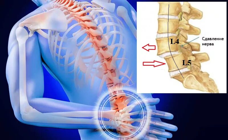 L4 отдел позвоночника. Ретролистез позвонка l1 l2 l3 2 мм. Ретролистез l1 и l2 позвонка что это такое. Ретролистез l2 1 степени. Ретролистез l4 позвонка поясничного отдела.