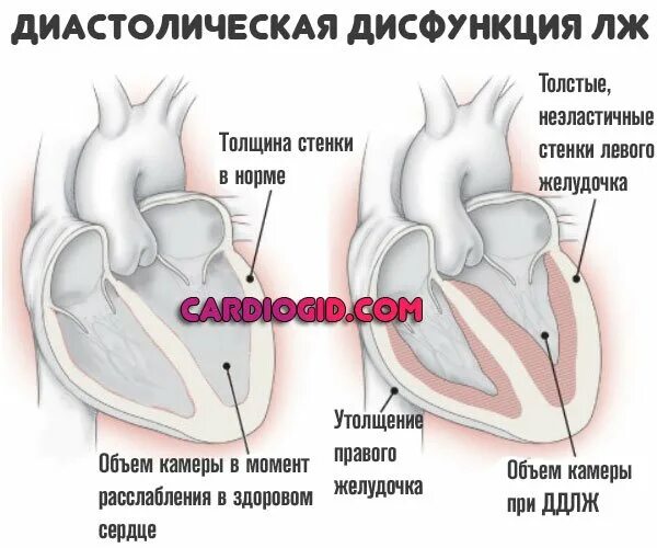 Диастолическая дисфункция левого желудочка 1 типа что это такое. Типы нарушения диастолической функции лж. Диастолическая функция левого желудочка сердца. Нарушение диастолической функции миокарда левого желудочка 2 типа.