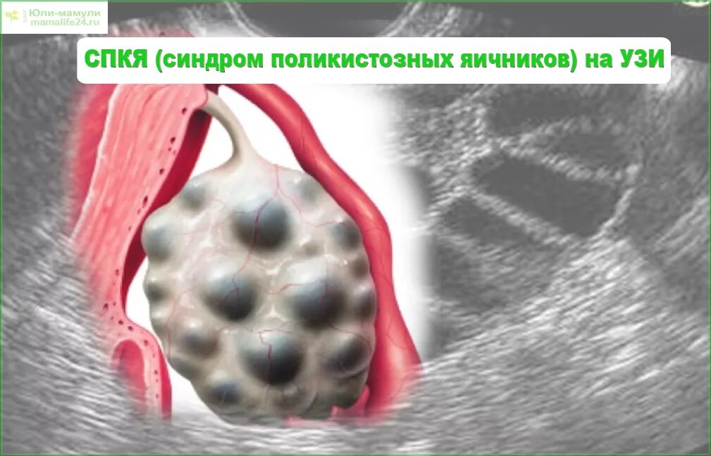 Поликистоз яичников форум. Поликистоз яичников (спкя). Поликистоз яичников форум. Поликистозная трансформация яичников. Синдром поликистозных яичников.