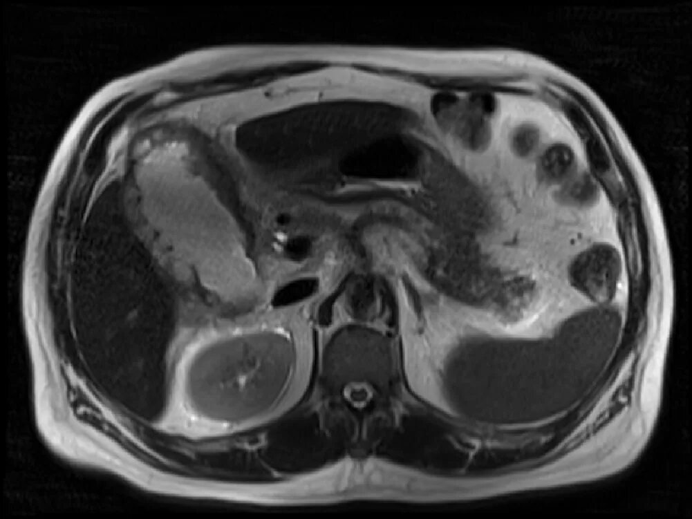 Эмпиема желчного пузыря кт. Эмпиема желчного пузыря мрт. Аденомиоматоз желчного пузыря кт. Аденоматоз желчного пузыря мрт. Камни в желчном кт
