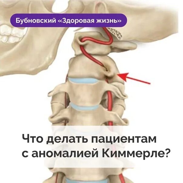 Аномалия киммерле первого шейного позвонка. Костный мостик киммерле. Шейные позвонки рентген аномалия киммерли. Аномалия киммерли в шейном отделе позвоночника рентген. Аномалия развития позвонка с1 киммерли.