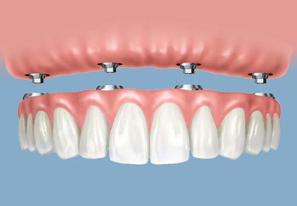 Протезирование зубов в казани. Имплантологическая кассета Nobel полный набор для all on 4. Аллон 4 протезирование. Протез челюсти на имплантах. Имплантация челюсти на 4 имплантах.