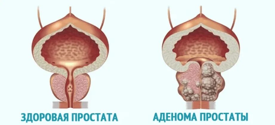 Доброкачественная гиперплазия (аденома) предстательной железы. Аденома предстательная железа у мужчин. Гиперплазия предстательной железы 1