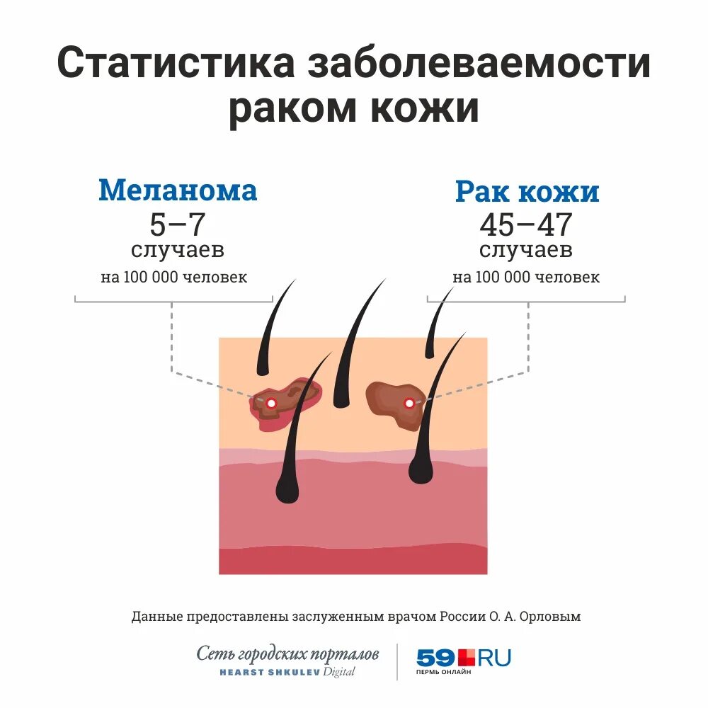 Распад кожи. Злокачественные новообразования кожи. Стадииразвития меланосомы.