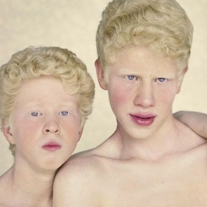 Альбинизм 1в. Глазокожный альбинизм 1 ГКА.