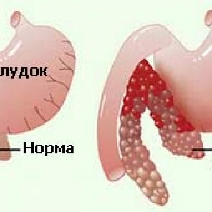 Что капают при панкреатите. Панкреатит капельницы. Капельницы при панкреатите. Капельница от поджелудочной железы. Капельница от поджелудочной железы названия.