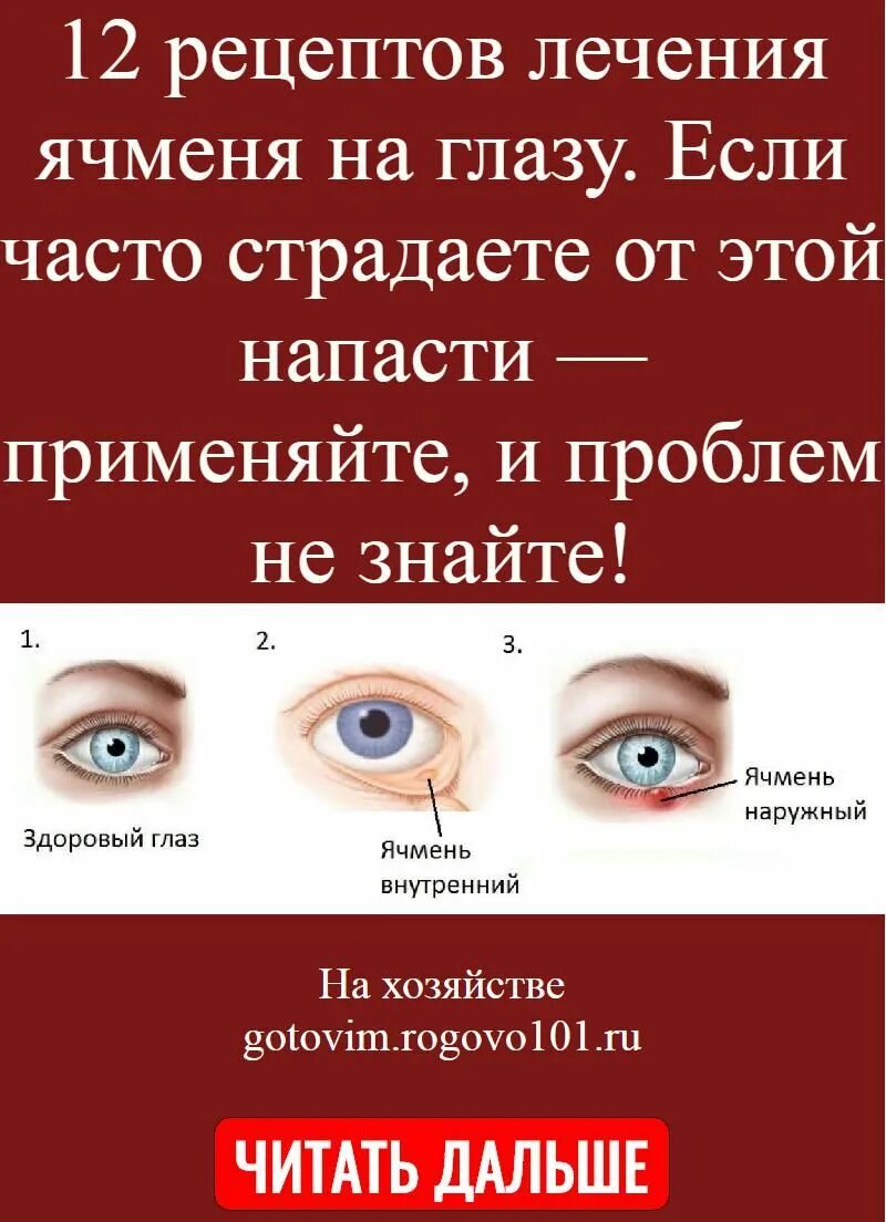 Сколько лечится ячмень. Как быстро вылечить ячмень на глазу. Ячмень на глазу стадии развития.