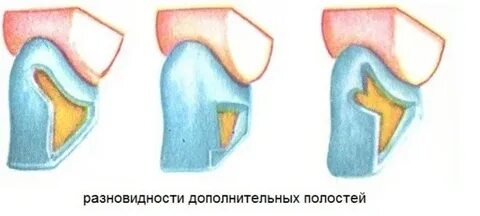 Наличие кариозных полостей