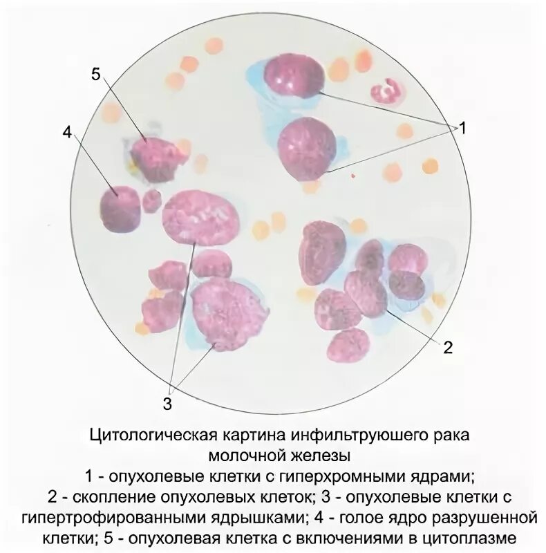 Цитологическое исследование пунктата. Карцинома молочной железы цитологическая картина. Цитологическое исследование РМЖ.