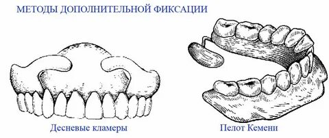 Фиксация полного съемного протеза