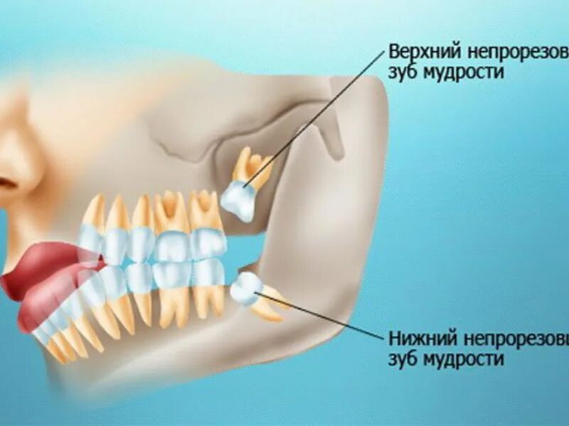 Мудрые зубы отзывы