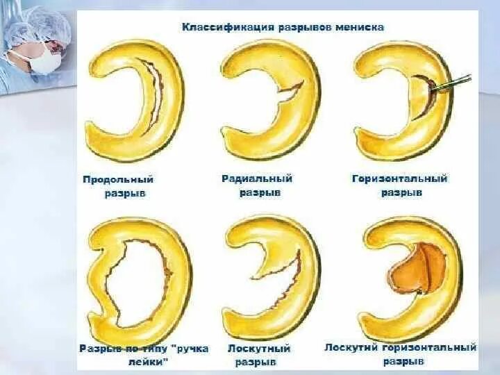 Повреждение менисков коленного сустава классификация. Косо горизонтальный разрыв внутреннего мениска коленного сустава. Косо горизонтальный разрыв медиального мениска 3 степени. Повреждение заднего рога внутреннего мениска коленного сустава.