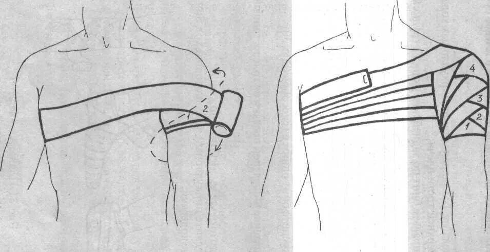 Плечевая повязка алгоритм. Перевязка колосовидная на плечо. 14. Наложение колосовидной повязки на плечо. Наложение колосовидной повязки на плечевой сустав. Колосовидная бинтовая повязка.