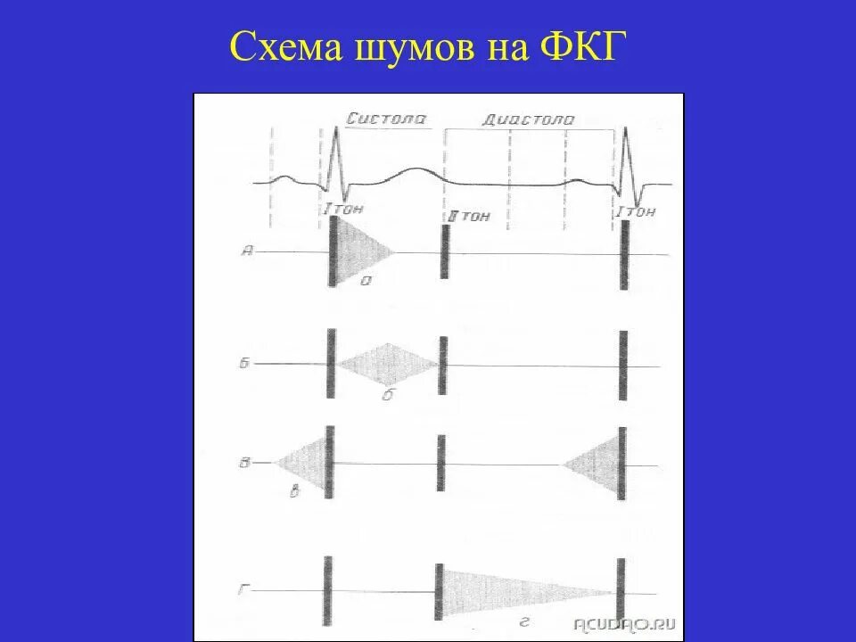 Аускультация тоны сердца ФКГ. Схема ФКГ. Схема шумов сердца. Тоны и шумы сердца ФКГ. Сердечные тоны шумы