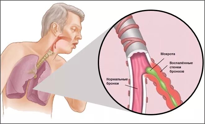 Острый обструктивный бронхит. Бронхит с обструкцией. Патология острого бронхита. Обструктивный бронхит бронхи.