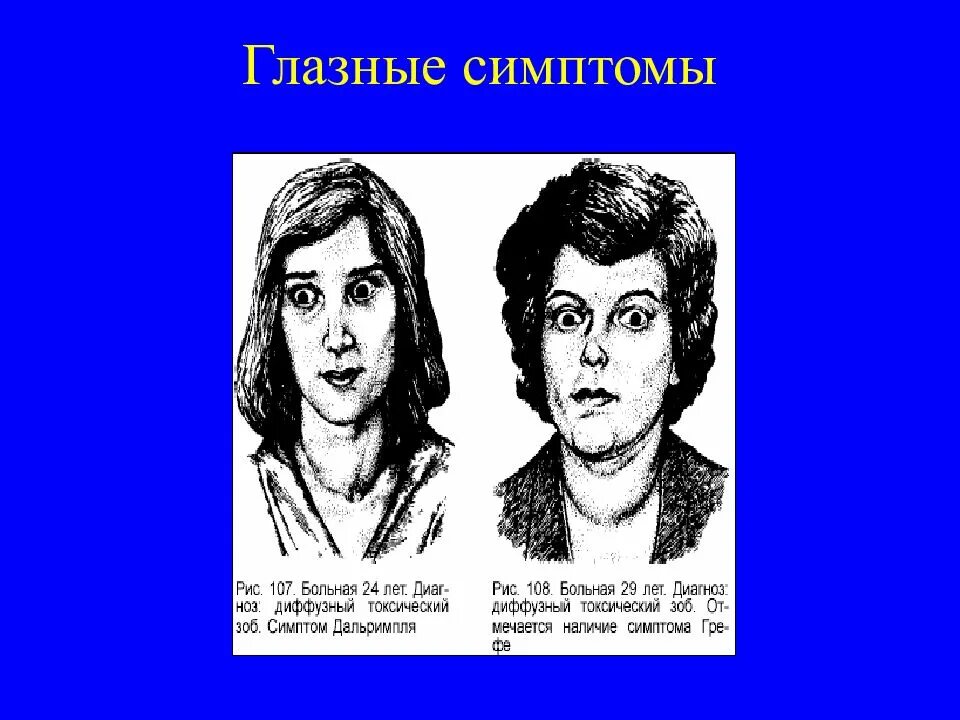 Гипертиреоз симптомы у женщин после 40. Гипотиреоз глазные симптомы. Гипотиреоз глазной синдром. Гипотиреоз и гипертиреоз.