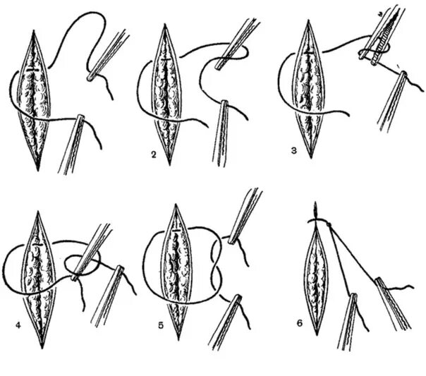 Узловатый шов хирургия. Наложение хирургического шва техника. Алгоритм наложения хирургических швов.