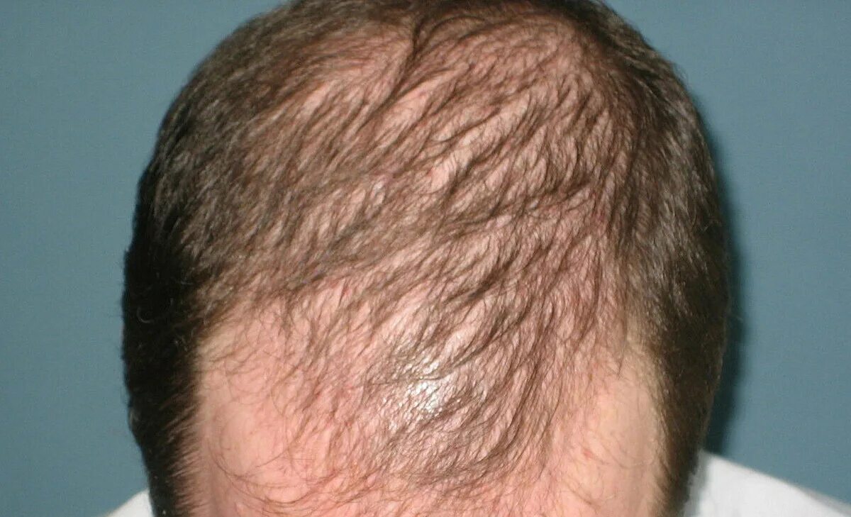 Очаговая алопеция (alopecia Areata). Гиперандрогенная алопеция. Андрогенная алопеция мкб 10. Андрогенная алопеция алопеция. Выпали волосы на висках