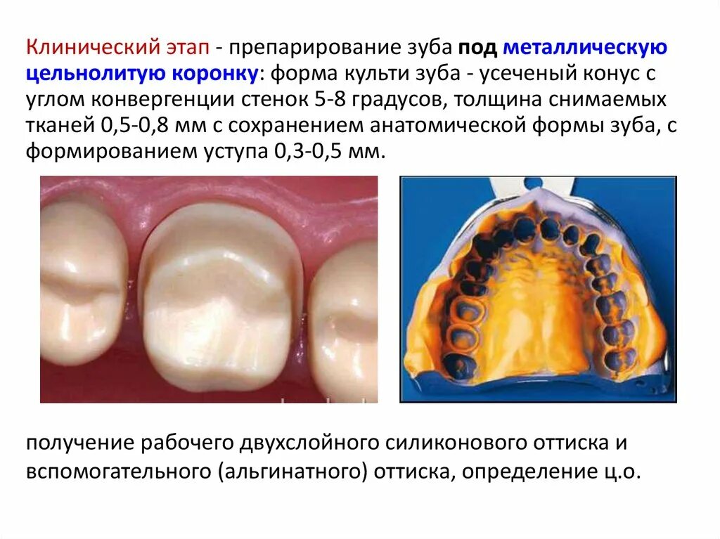 Штампованные и цельнолитые коронки. Моделировка штампованных коронок резец. Коронка цельнолитая кхс. Паяный мостовидный протез с фасетками. Штампованная коронка.