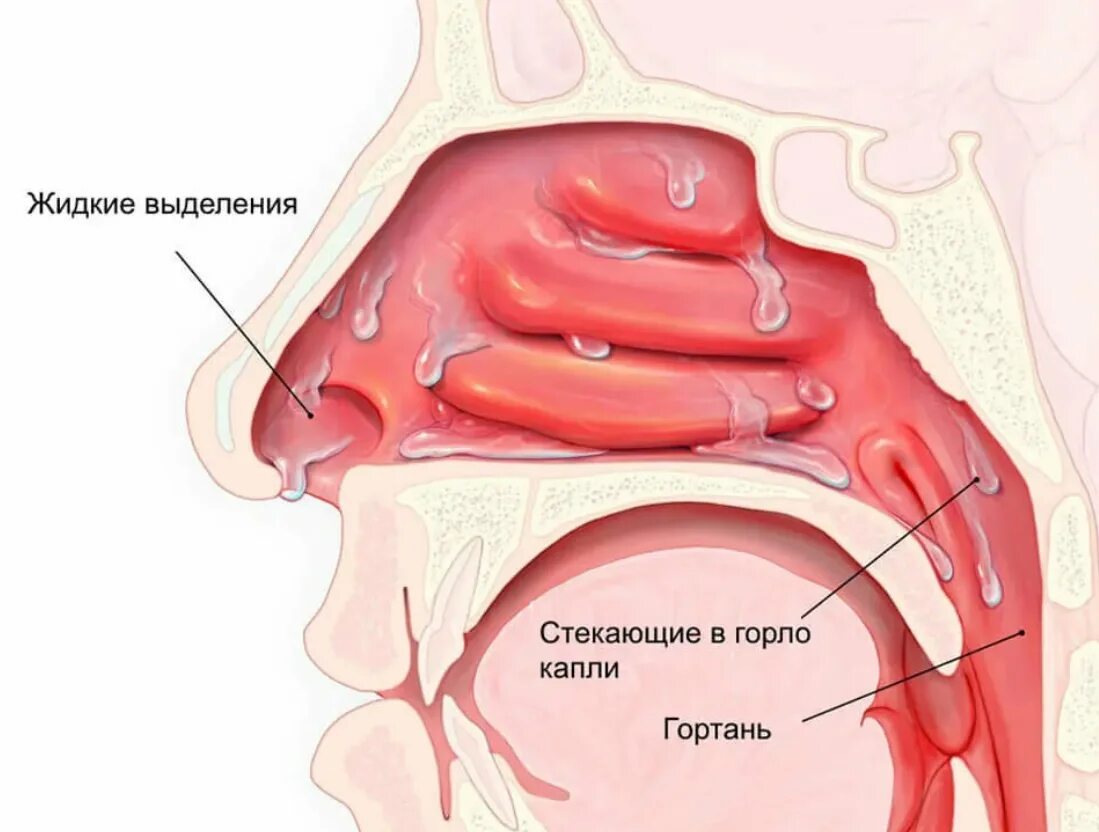 Зачем насморк. Вазомоторный ринит носовые раковины. Анатомия носоглотки аденоиды. Аллергический ринит слизистая носа. Ринит это заболевание носовой полости.