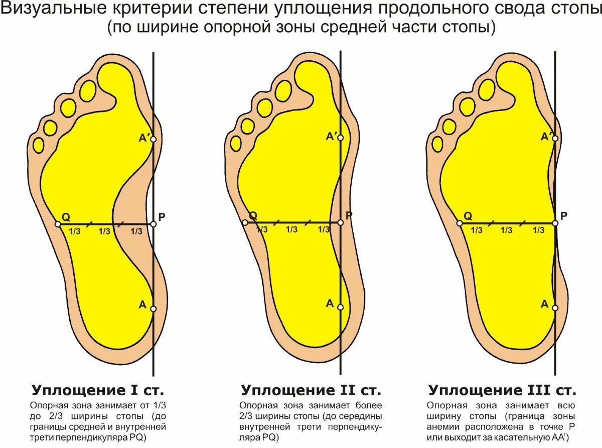 Продольное плоскостопие этиология. Высота свода плоскостопие 2 степени. Степени развития плоскостопия. Поперечное плоскостопие отпечаток стопы.