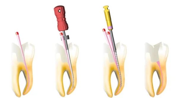 Обработка и пломбирование корневых каналов