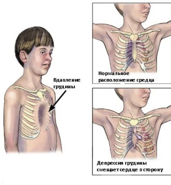 Деформация грудной клетки, килевидная или воронкообразная. Воронкообразная деформация скелета грудной клетки. 2. Воронкообразная деформация грудной клетки.. Исправление воронкообразной деформации грудной клетки. Грудная клетка у ребенка норма