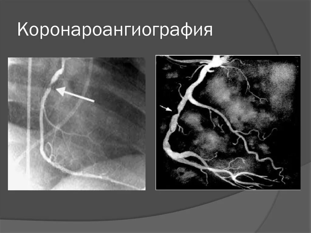 Коронароангиография стенокардия. Коронароангиография ИБС. Рентгеноконтрастная коронарография. Коронарография сосудов.