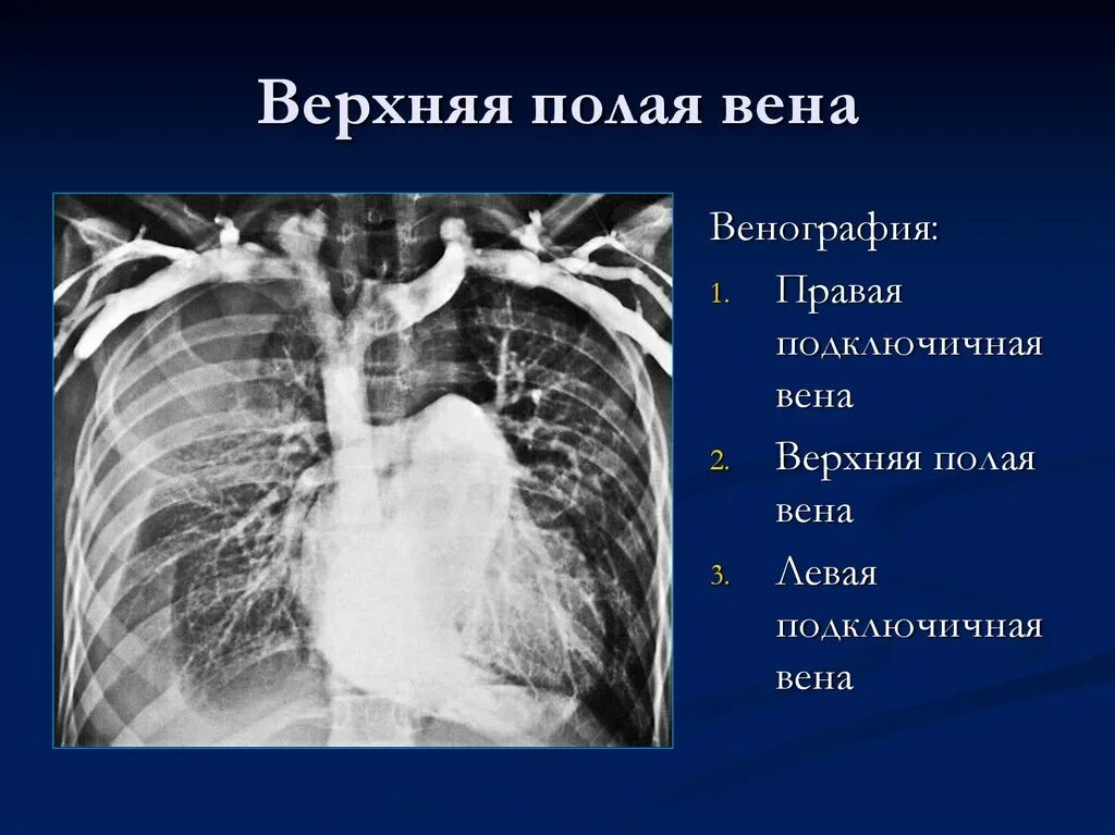 Левая подключичная вена. Расширена верхняя полая Вена на рентгене. ОГК верхняя полая Вена. Расширение верхней полой вены на рентгене. Верхняя полая Вена рентген.