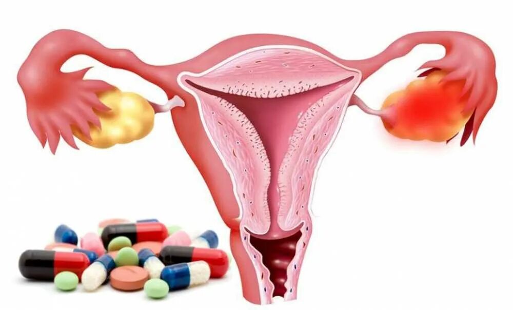 Хронический острый оофорит. Воспаление маточных труб. Трихомонадный сальпингит. Оофорит (воспаление яичников) симптомы. Гонорейный сальпингит.