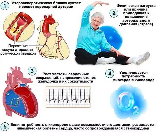 Заболевания сердца при стрессе. Профилактика стенокардии сердца. Стенокардия при физической нагрузке. Профилактика заболевания ИБС стенокардии. Боли при ишемии