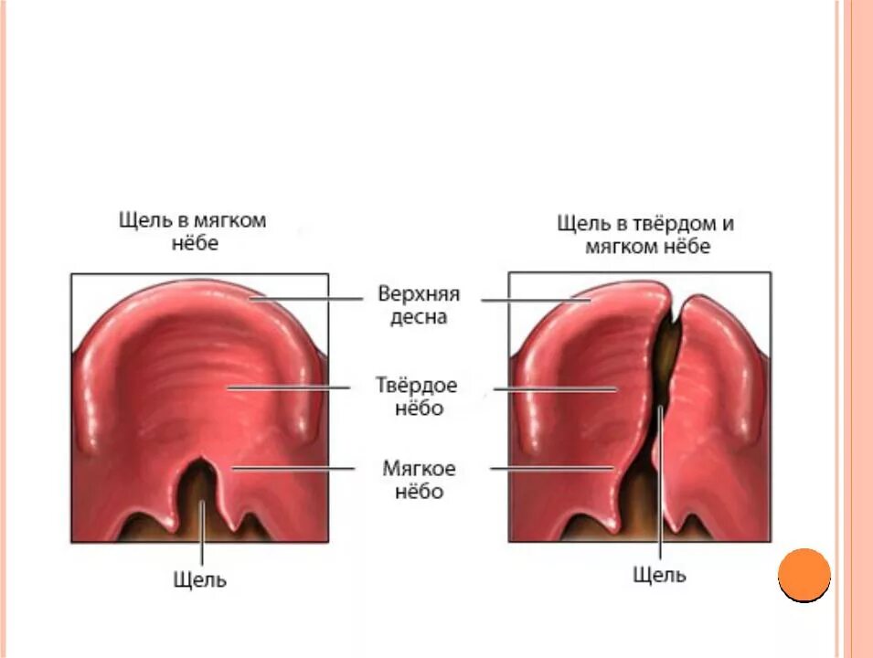 Ринолалия расщелина мягкого неба.