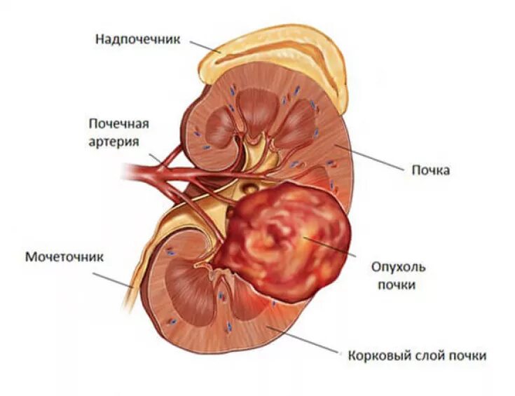 Доброкачественная опухоль почечной лоханки. Опухоли паренхимы почек. Карцинома лоханки почки. Опухоли почечной паренхимы фиброма. Рак почки причины