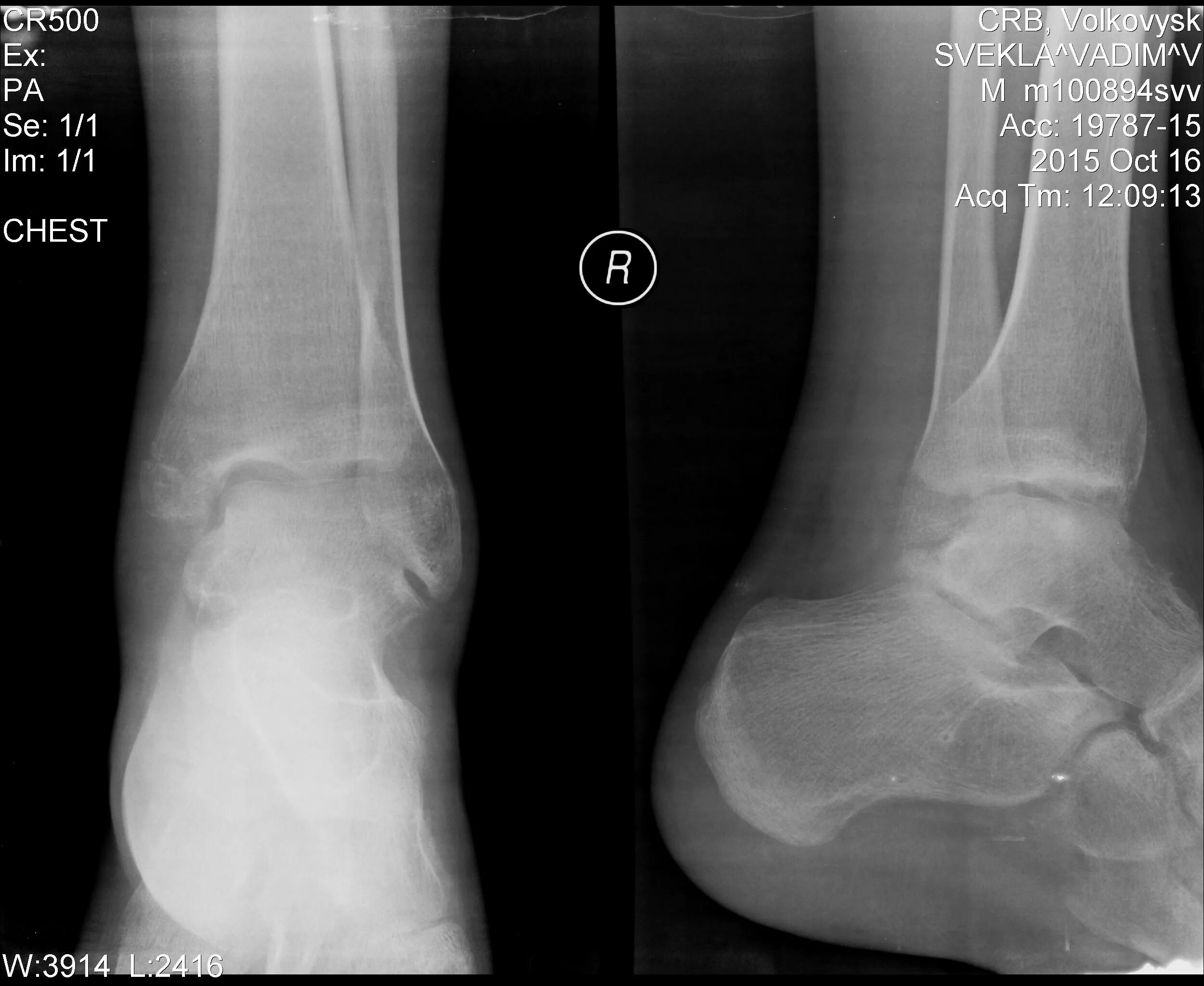 Пронационный перелом лодыжки. Лодыжка без смещения. Абдукционный перелом лодыжки. Перелом наружной лодыжки рентген. Лодыжка без смещения.