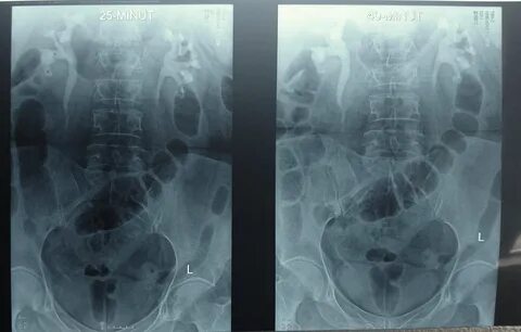 Подковообразная почка: рентген и урография - примеры и особенности Визуальные аф