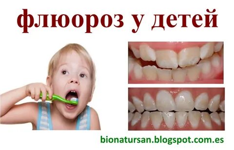 Лечение флюороза