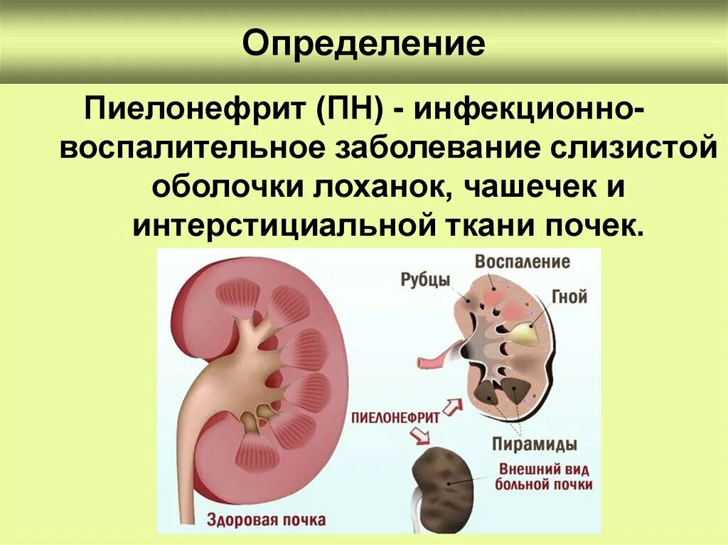 Пиелонефрит что поражается. Пиелонефрит на латинском. Наиболее частой причиной развития пиелонефрита является. Острый пиелонефрит болезнь